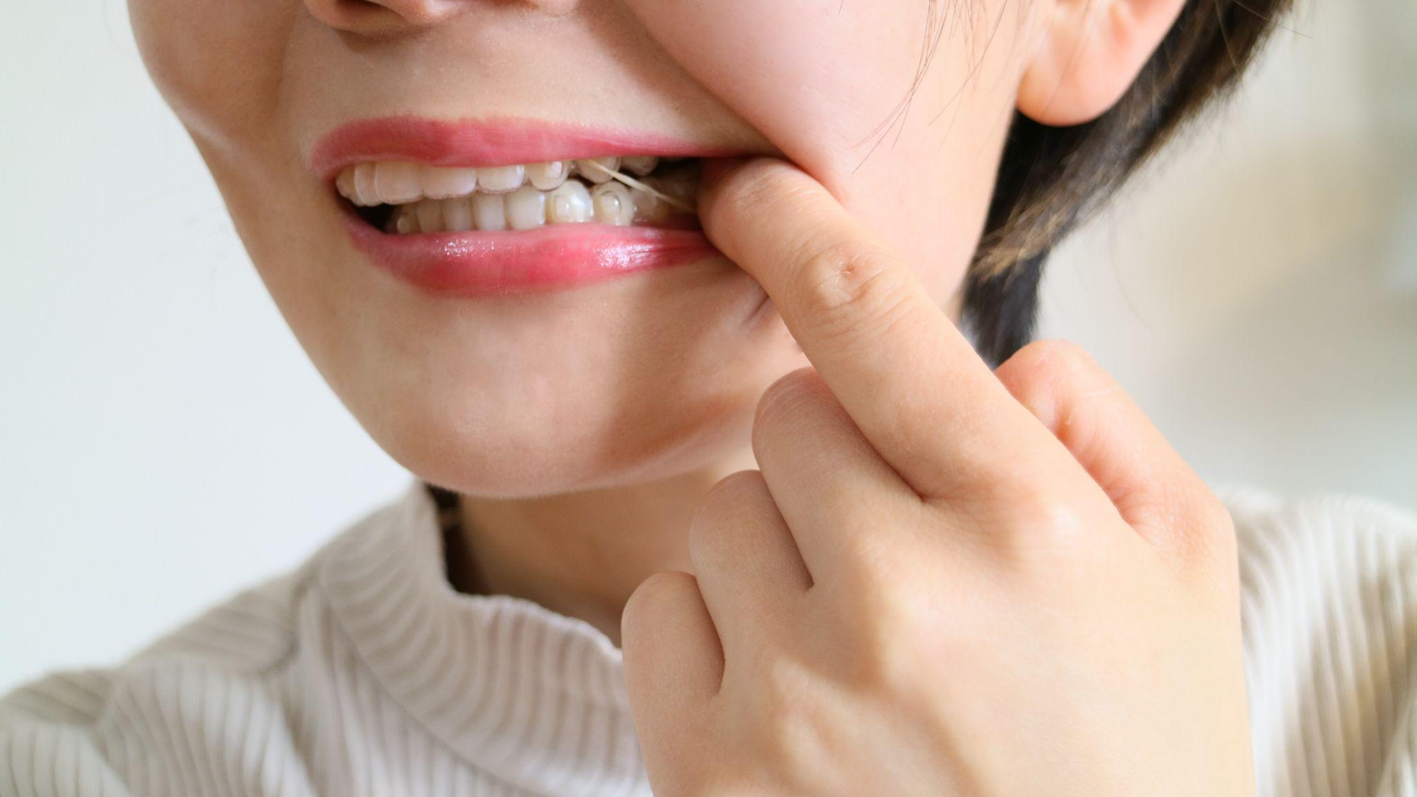 インビザラインのゴムかけとは？役割や効果などを解説