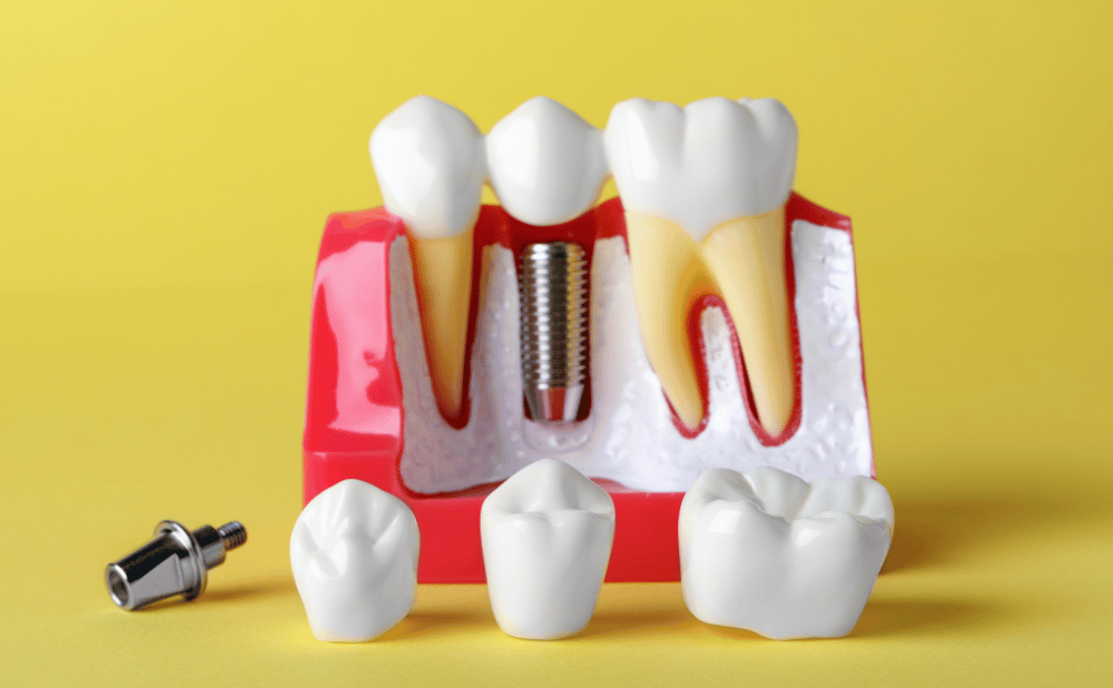 星ヶ丘でインプラント治療ができるおすすめ歯科医院3選！格安な治療はどうなのか？
