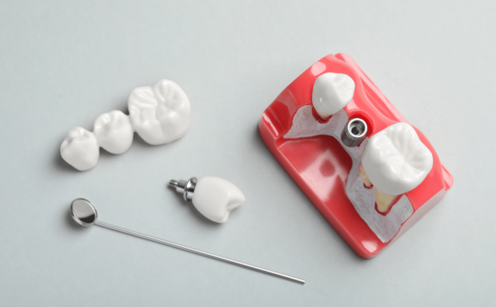 本山付近でインプラント治療などの評判が良い歯科医院3選！