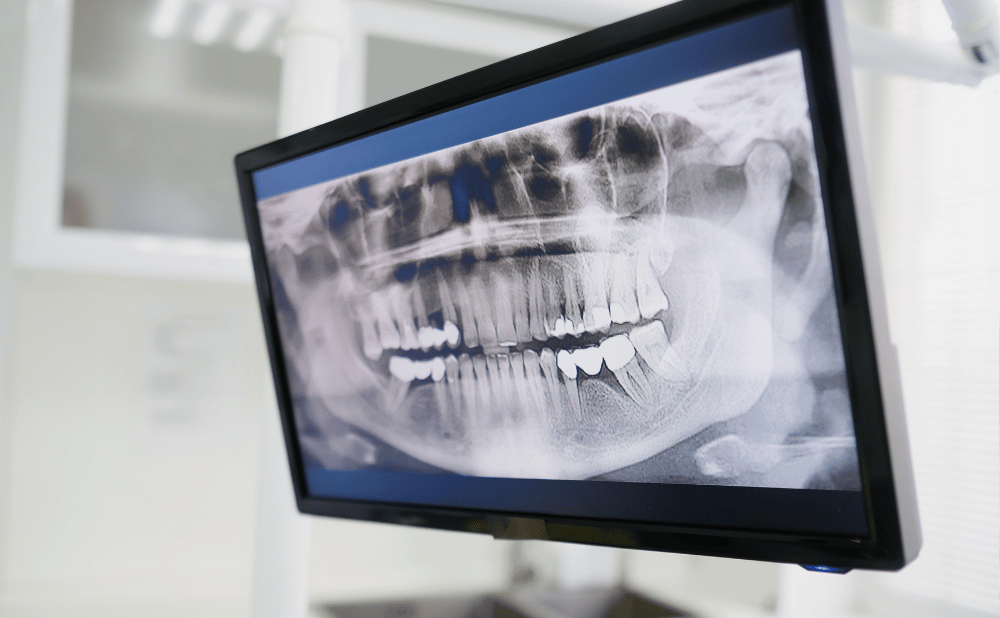 インプラント治療における難症例とは