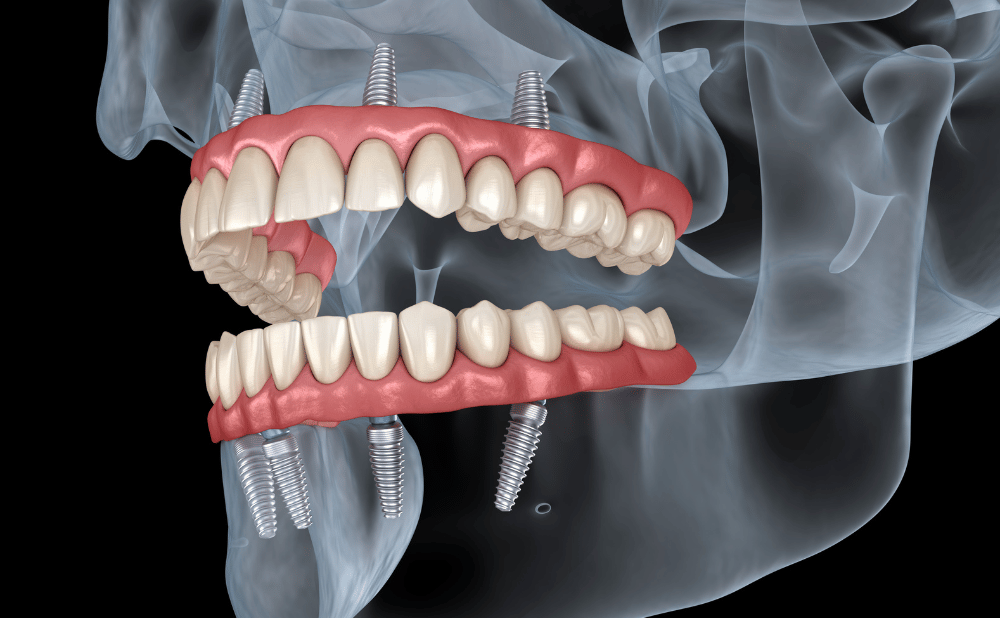 オールオンフォーの費用相場はどのくらい？低コストで治療する方法！
