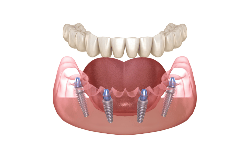 名古屋でオールオンフォー治療を受けるなら？実績豊富な名医の見分け方