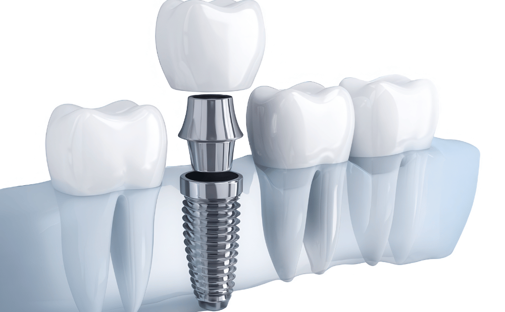 名古屋で難症例のインプラント治療を受けるなら？歯科医院選びのポイントと安心の治療法