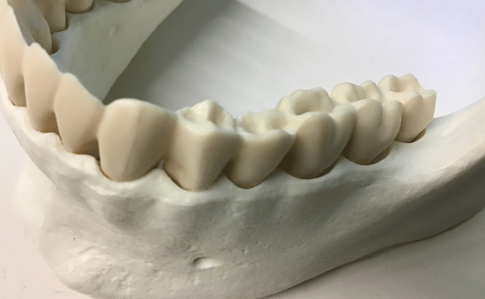 インビザラインのアタッチメントはなぜ必要なのか？